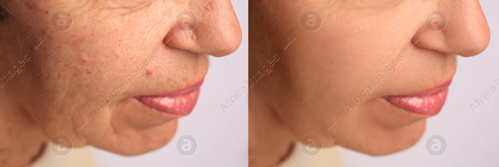 Image of Woman before and after rejuvenating procedures. Collage with photos on white background, closeup