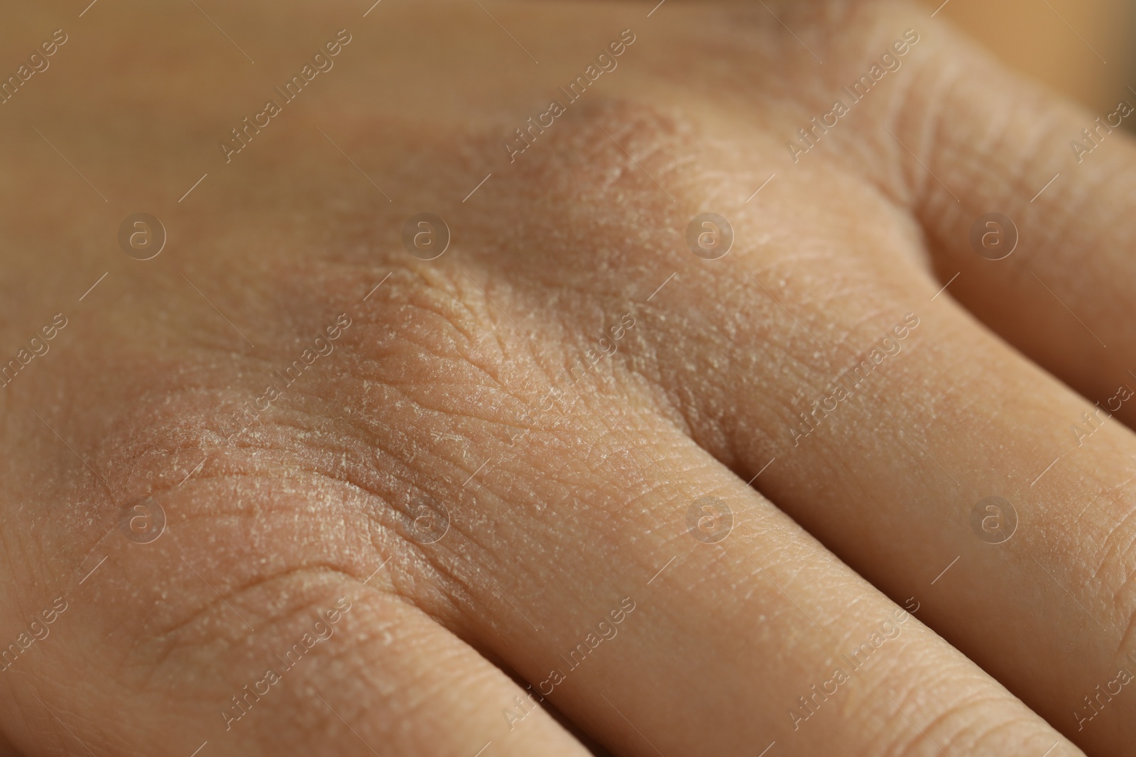 Photo of Closeup view of person with dry skin on hand
