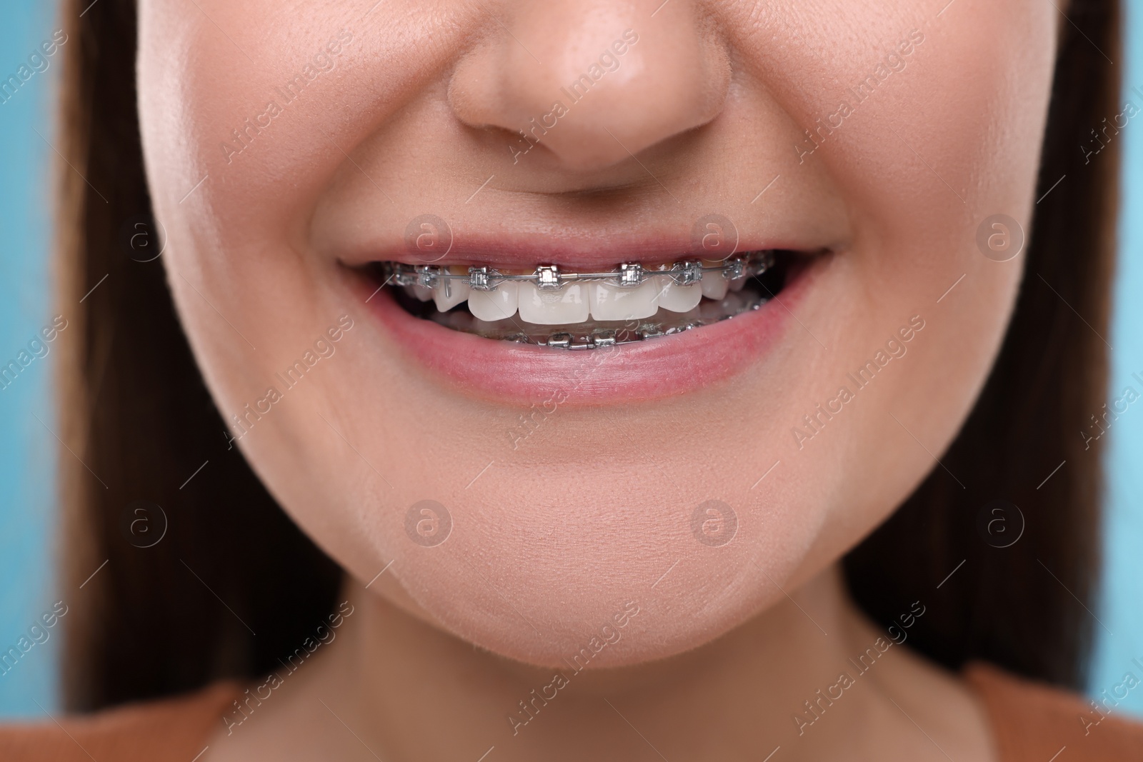 Photo of Smiling woman with dental braces, closeup view