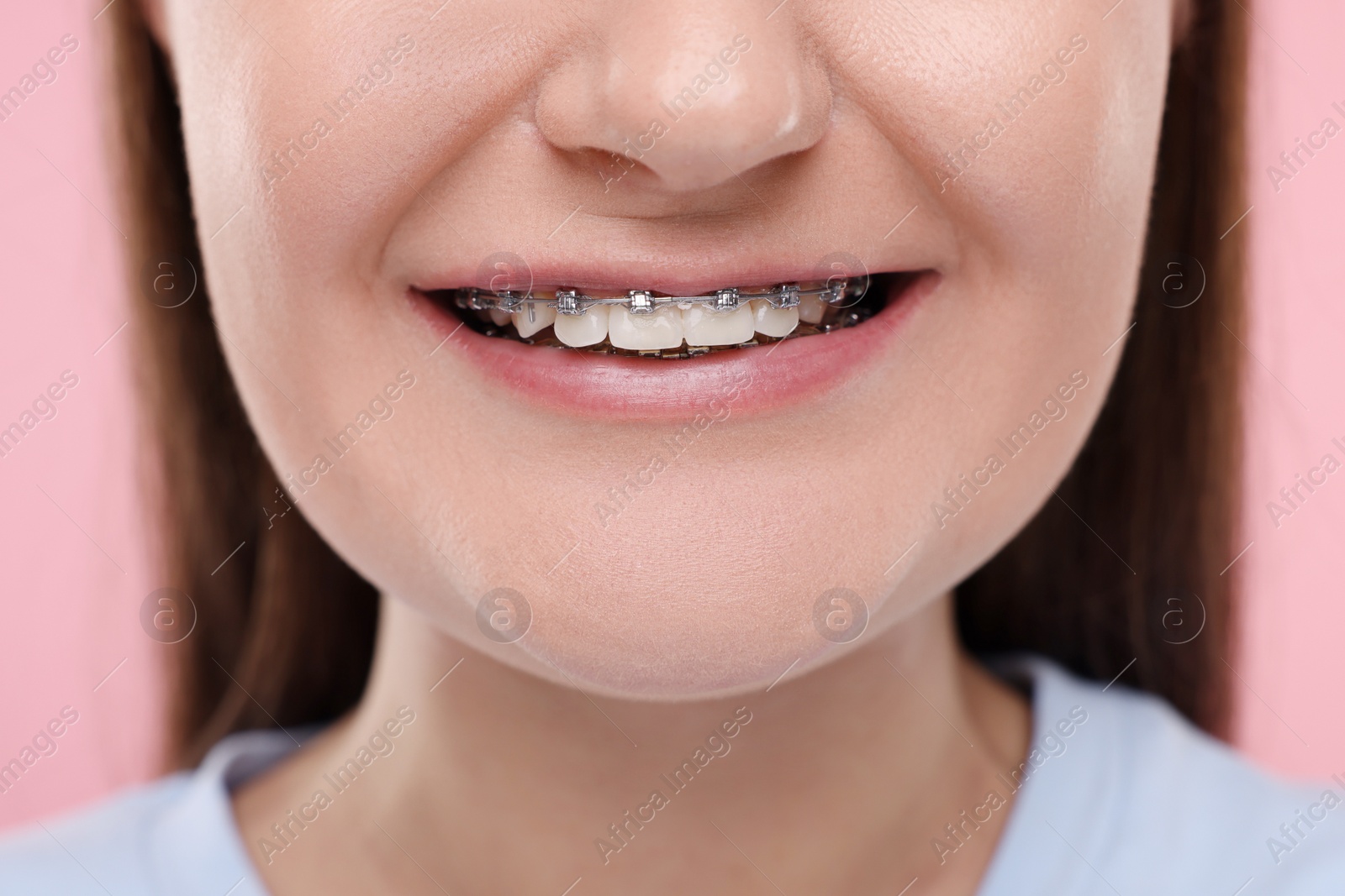 Photo of Smiling woman with dental braces on pink background, closeup