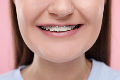 Photo of Smiling woman with dental braces on pink background, closeup