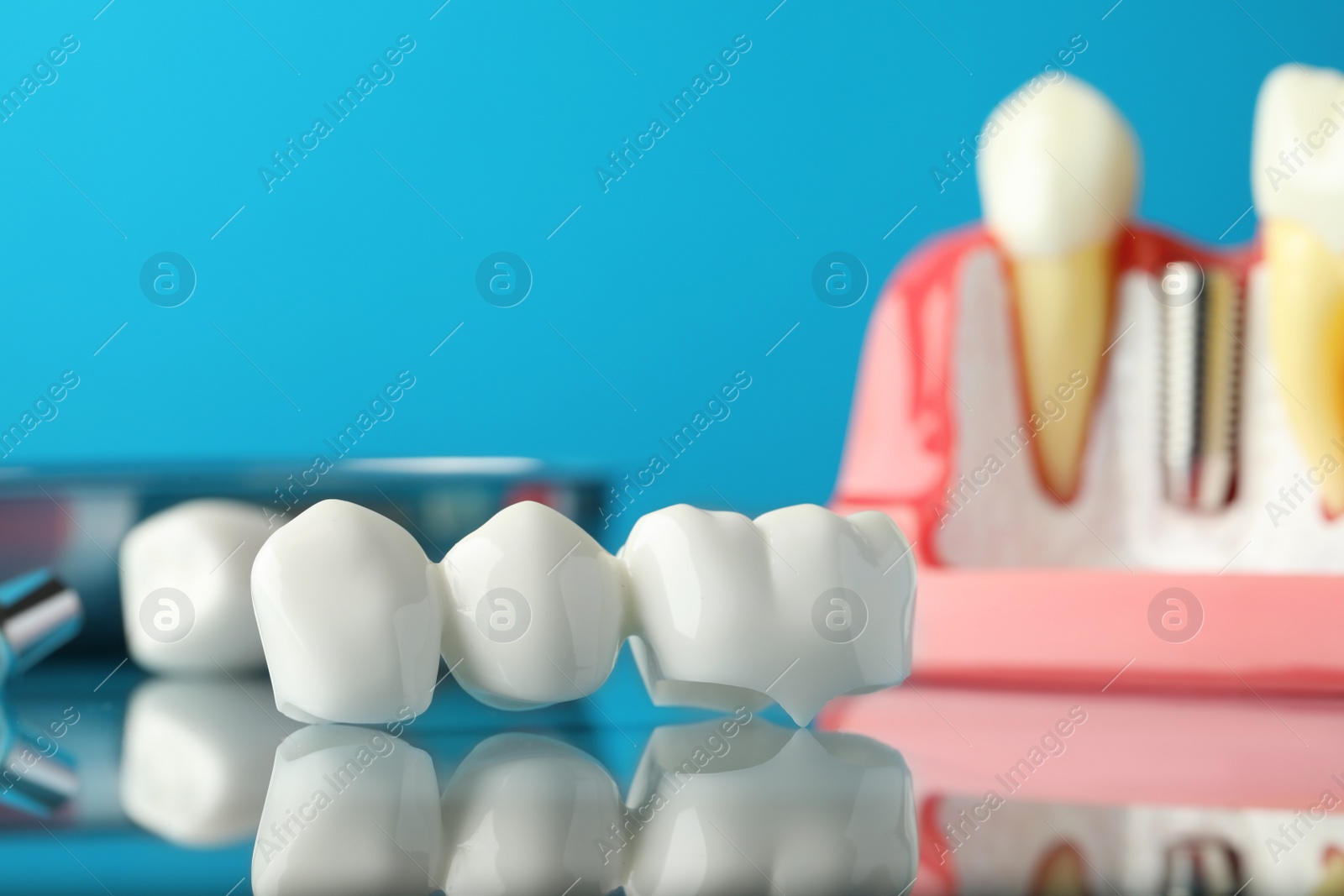 Photo of Dental bridge near educational model of gum with implant on light blue background, closeup