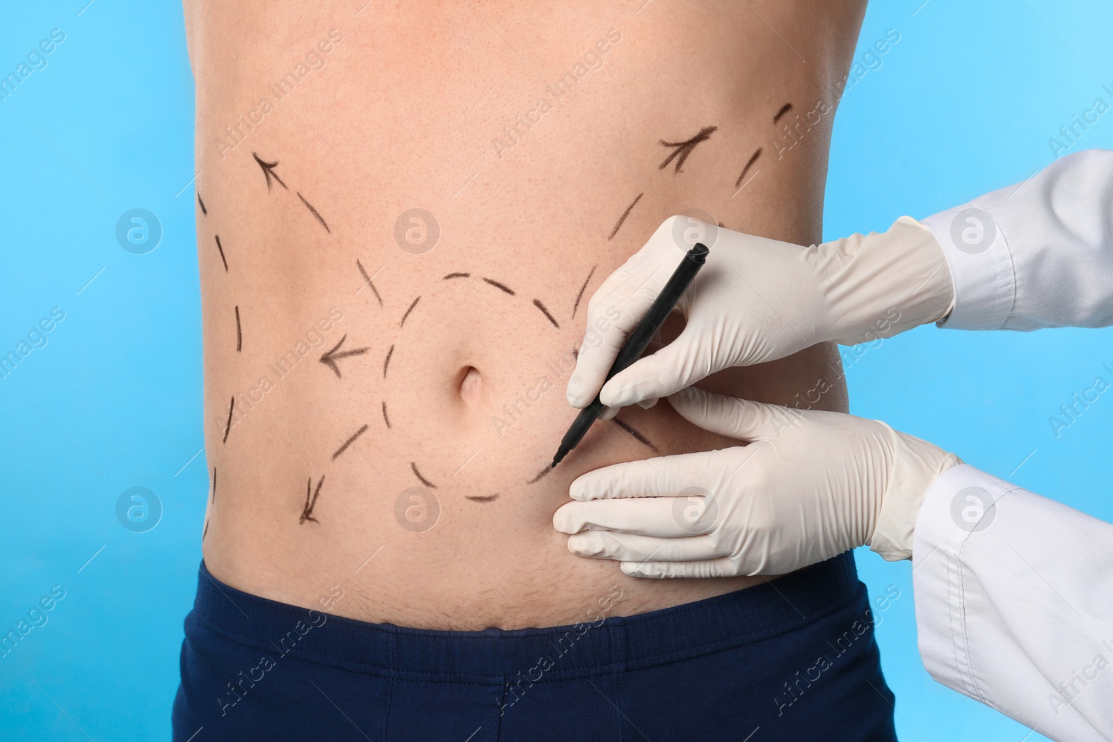 Photo of Doctor drawing marks on man's body for cosmetic surgery operation against blue background, closeup