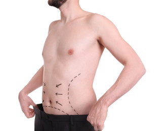 Young man with marks on belly for cosmetic surgery operation on white background