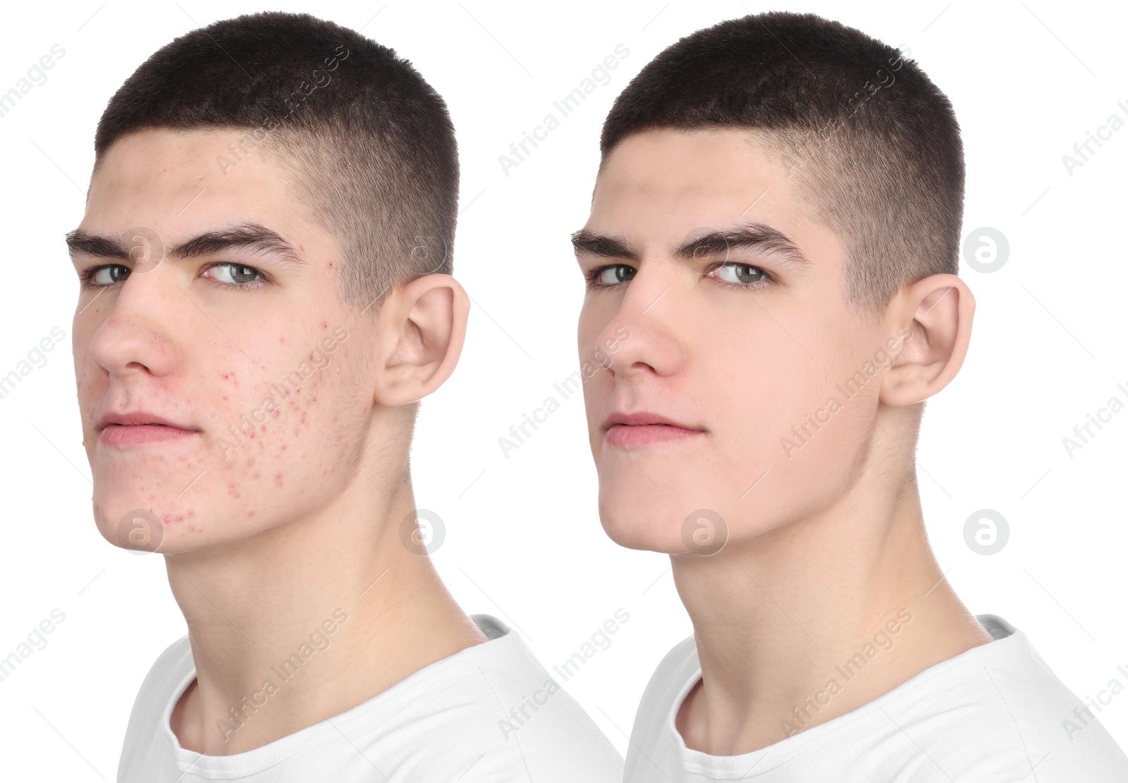 Image of Acne problem. Young man before and after treatment on white background, collage of photos