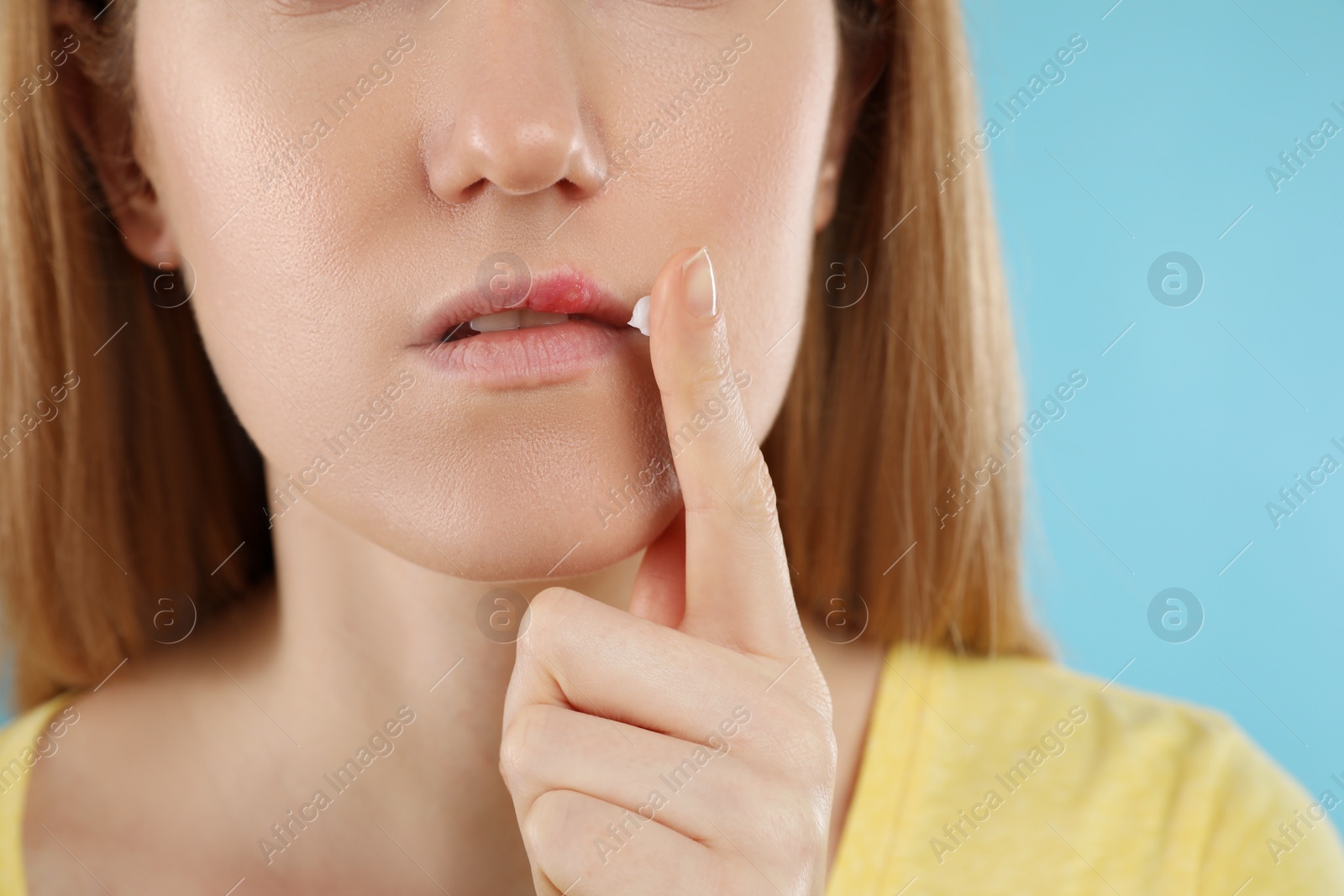 Photo of Woman with herpes applying cream on lips against light blue background, closeup