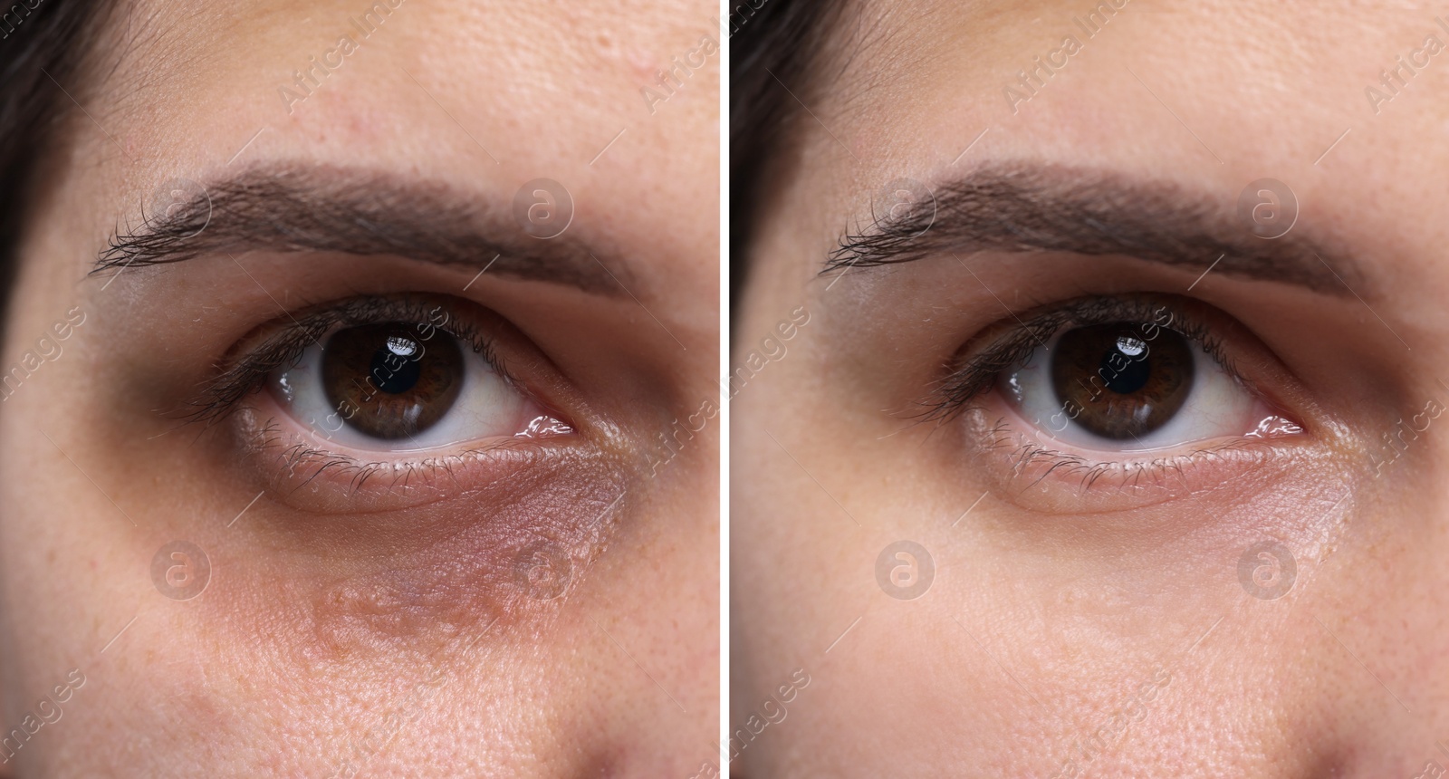 Image of Collage with photos of woman with dark circle under eye before and after treatment, closeup