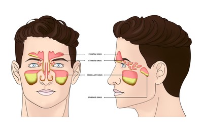 Illustration of  man with inflammed paranasal sinuses on white background
