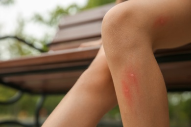 Photo of Girl with insect bites on leg outdoors, closeup