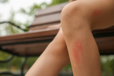 Girl with insect bites on leg outdoors, closeup