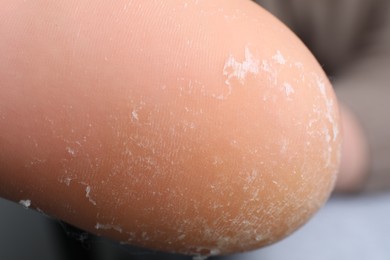 Photo of Woman with dry skin on foot, closeup