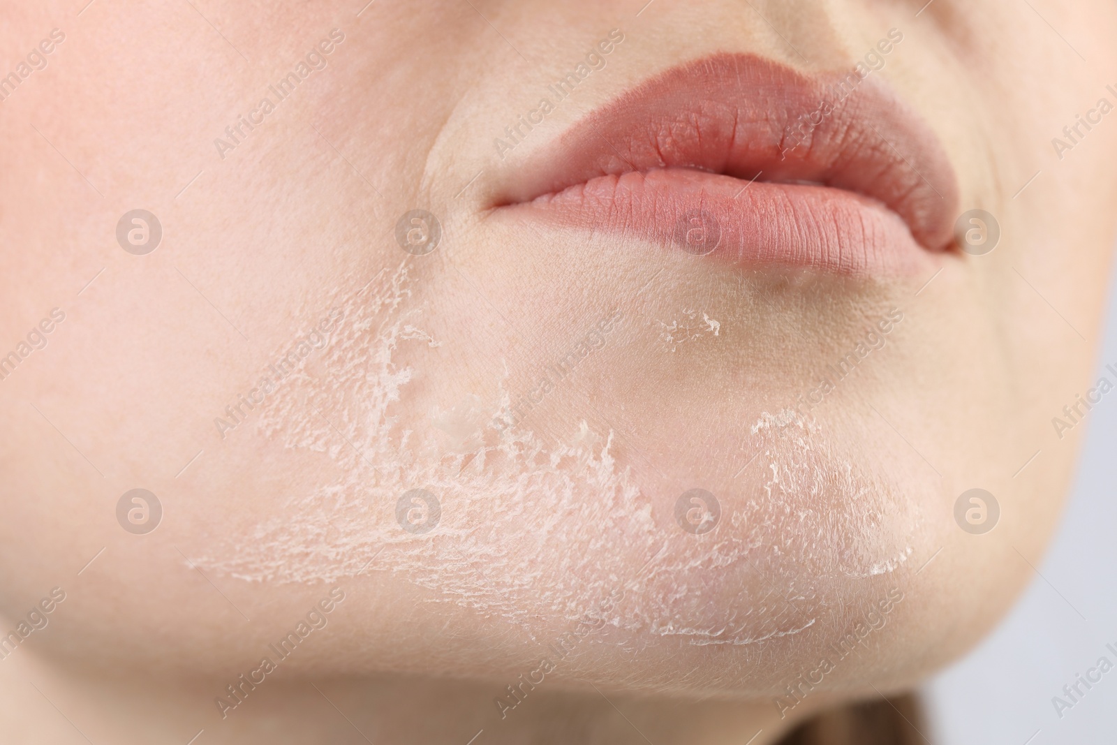 Photo of Closeup view of woman with dry skin