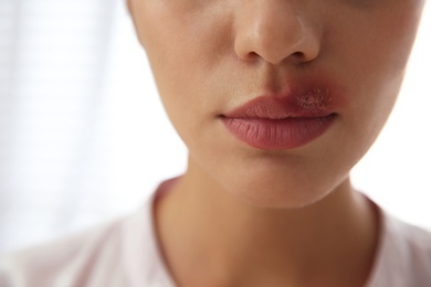 Woman with herpes on lip against light background, closeup