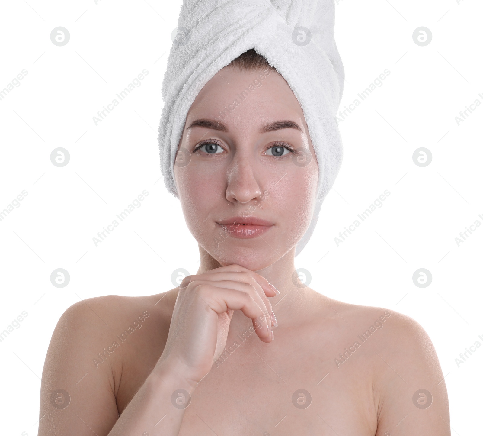 Photo of Young woman with acne problem on white background