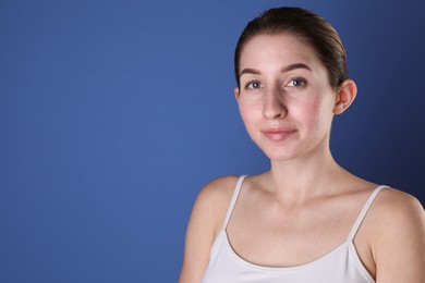 Young woman with acne problem on blue background. Space for text