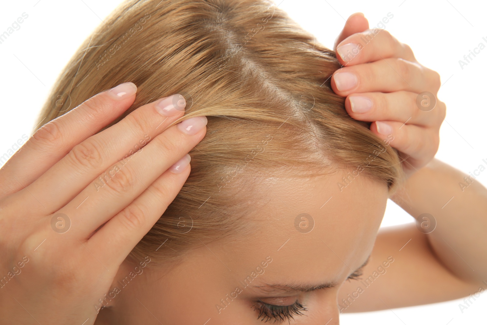 Photo of Woman with hair loss problem on white background, closeup. Trichology treatment