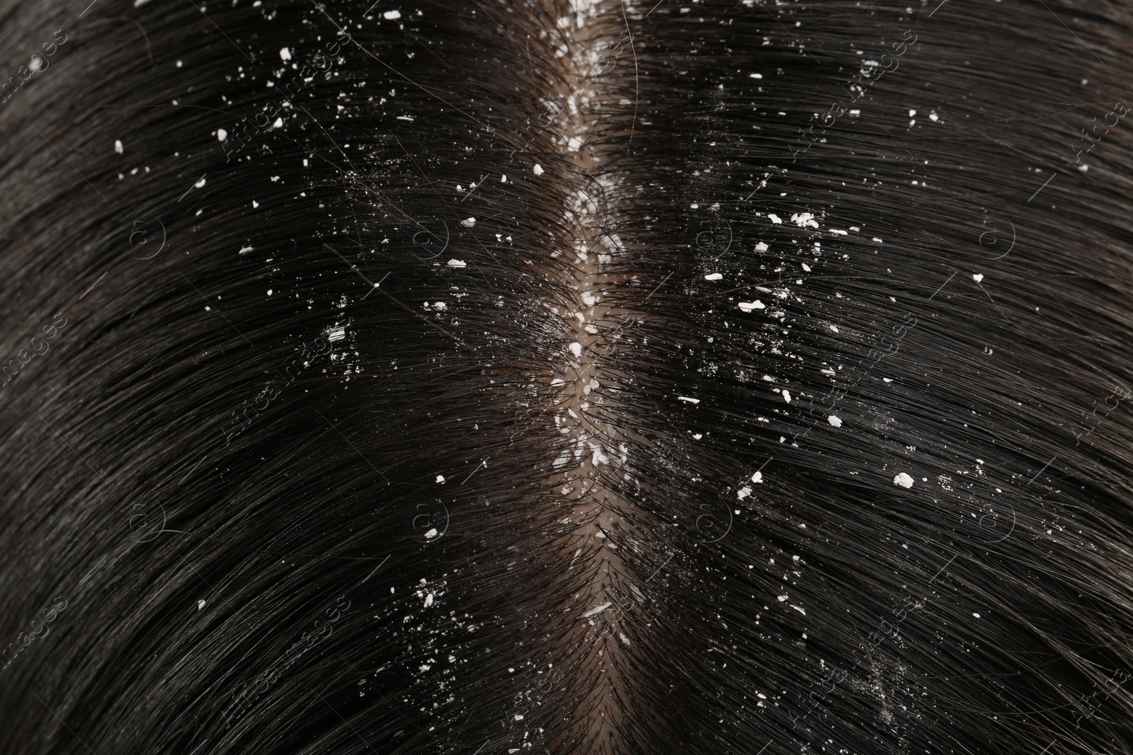 Photo of Woman with dandruff in her dark hair, closeup view