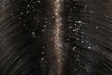 Woman with dandruff in her dark hair, closeup view