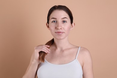 Young woman with acne problem on beige background