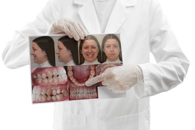 Doctor holding photo of woman and her teeth from different sides on white background, closeup