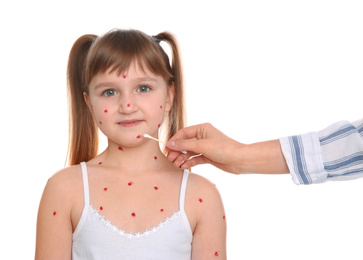 Woman applying cream onto skin of little girl with chickenpox on white background