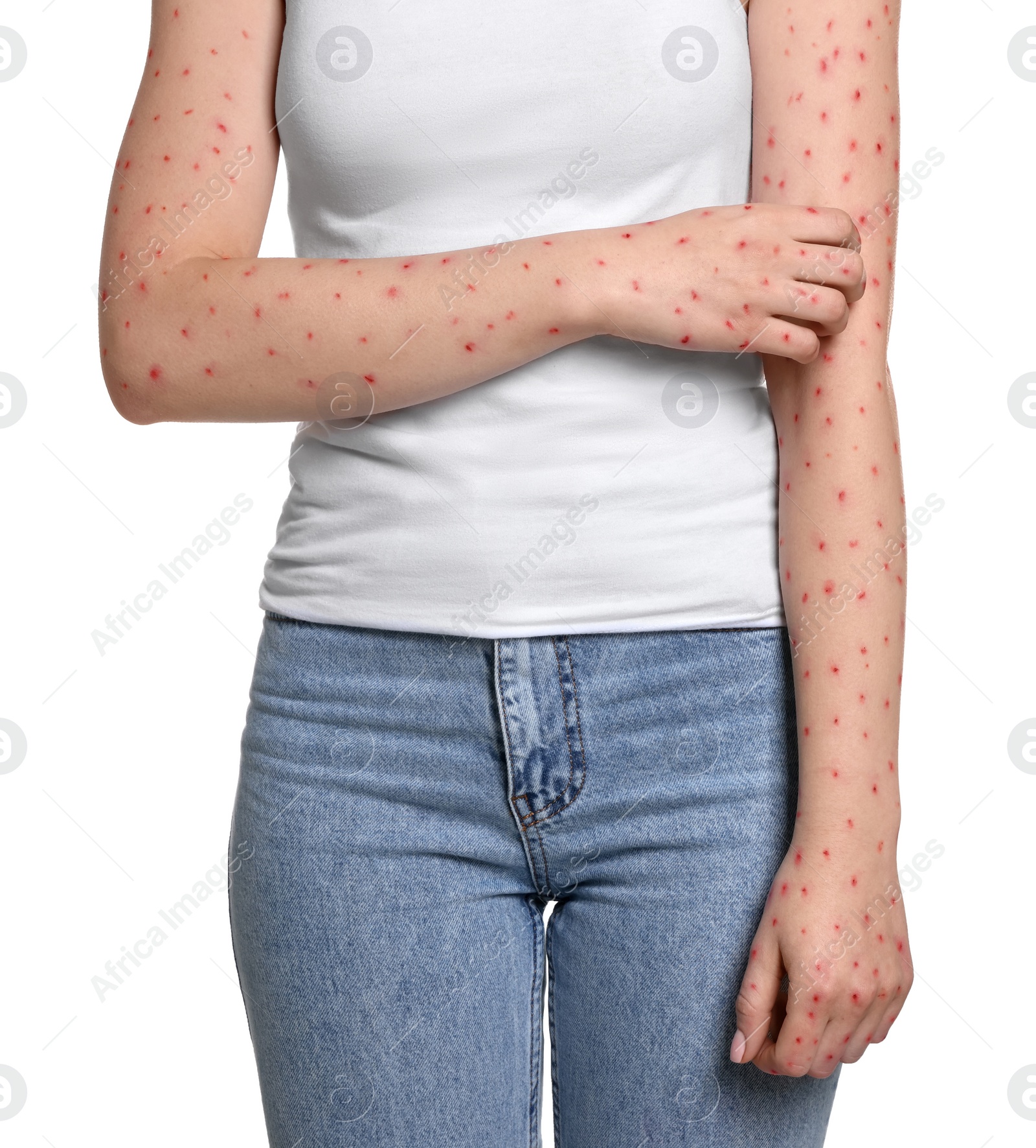 Image of Woman with rash suffering from monkeypox virus on white background, closeup