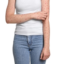 Woman with rash suffering from monkeypox virus on white background, closeup