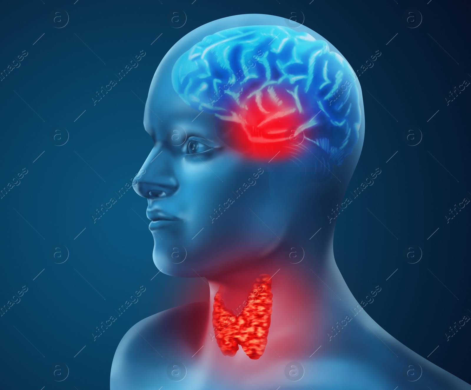 Illustration of  human with inflamed thyroid gland on color background