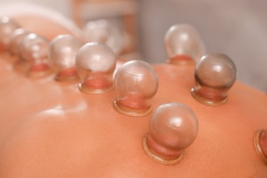 Cupping therapy. Closeup view of man with glass cups on his back indoors