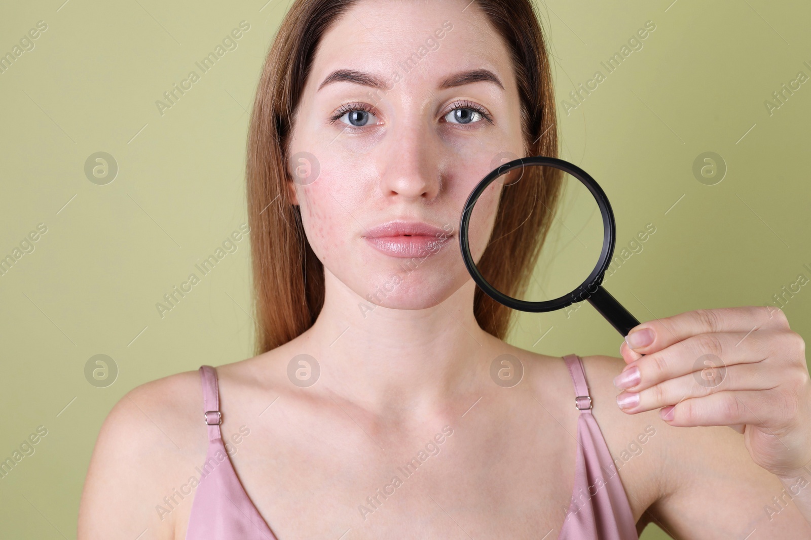 Photo of Young woman with acne problem holding magnifying glass near her skin on olive background