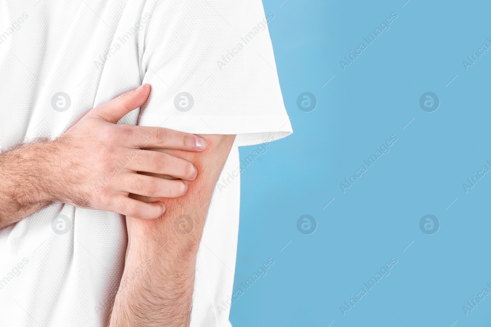 Photo of Man scratching hand on color background, closeup with space for text. Allergies symptoms