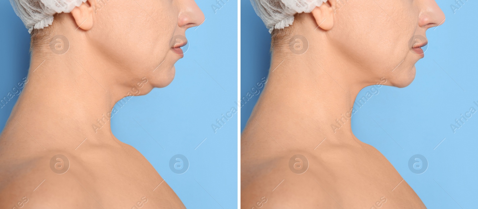 Image of Mature woman before and after plastic surgery operation on blue background, closeup. Double chin problem