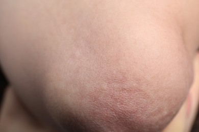 Photo of Woman with dry skin on elbow, closeup