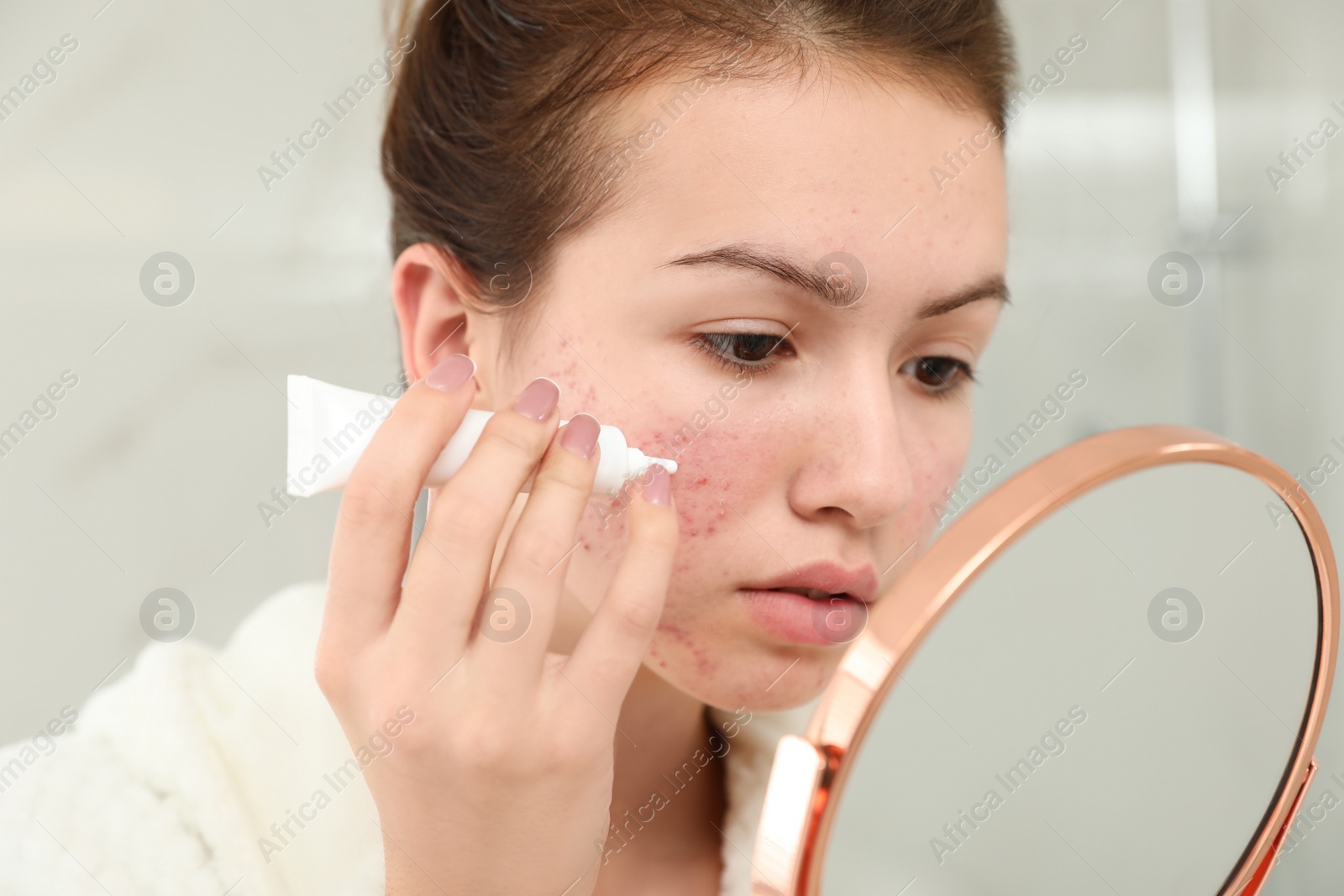 Photo of Teen girl with acne problem applying cream using mirror in bathroom