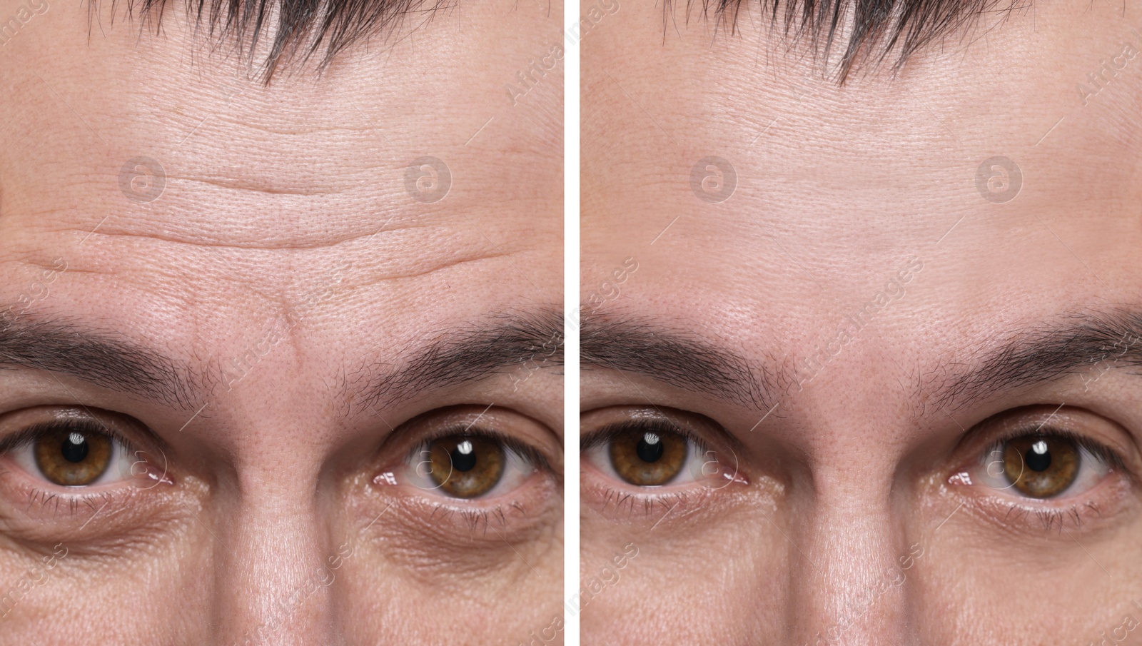 Image of Aging skin changes. Man showing face before and after rejuvenation, closeup. Collage comparing skin condition