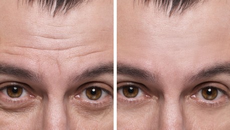 Aging skin changes. Man showing face before and after rejuvenation, closeup. Collage comparing skin condition