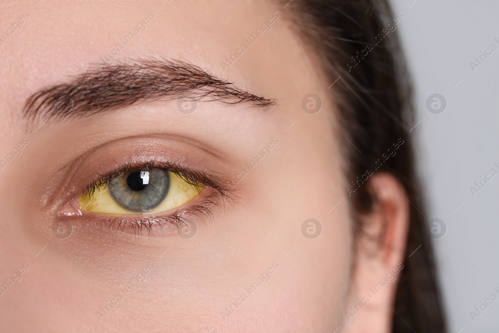 Photo of Woman with yellow eyes on light background, closeup. Symptom of hepatitis