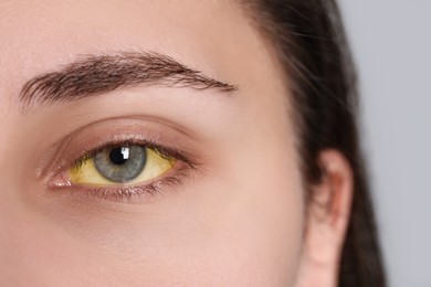 Woman with yellow eyes on light background, closeup. Symptom of hepatitis