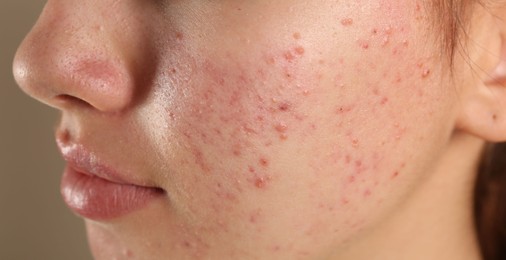 Teenage girl with acne problem on beige background, closeup