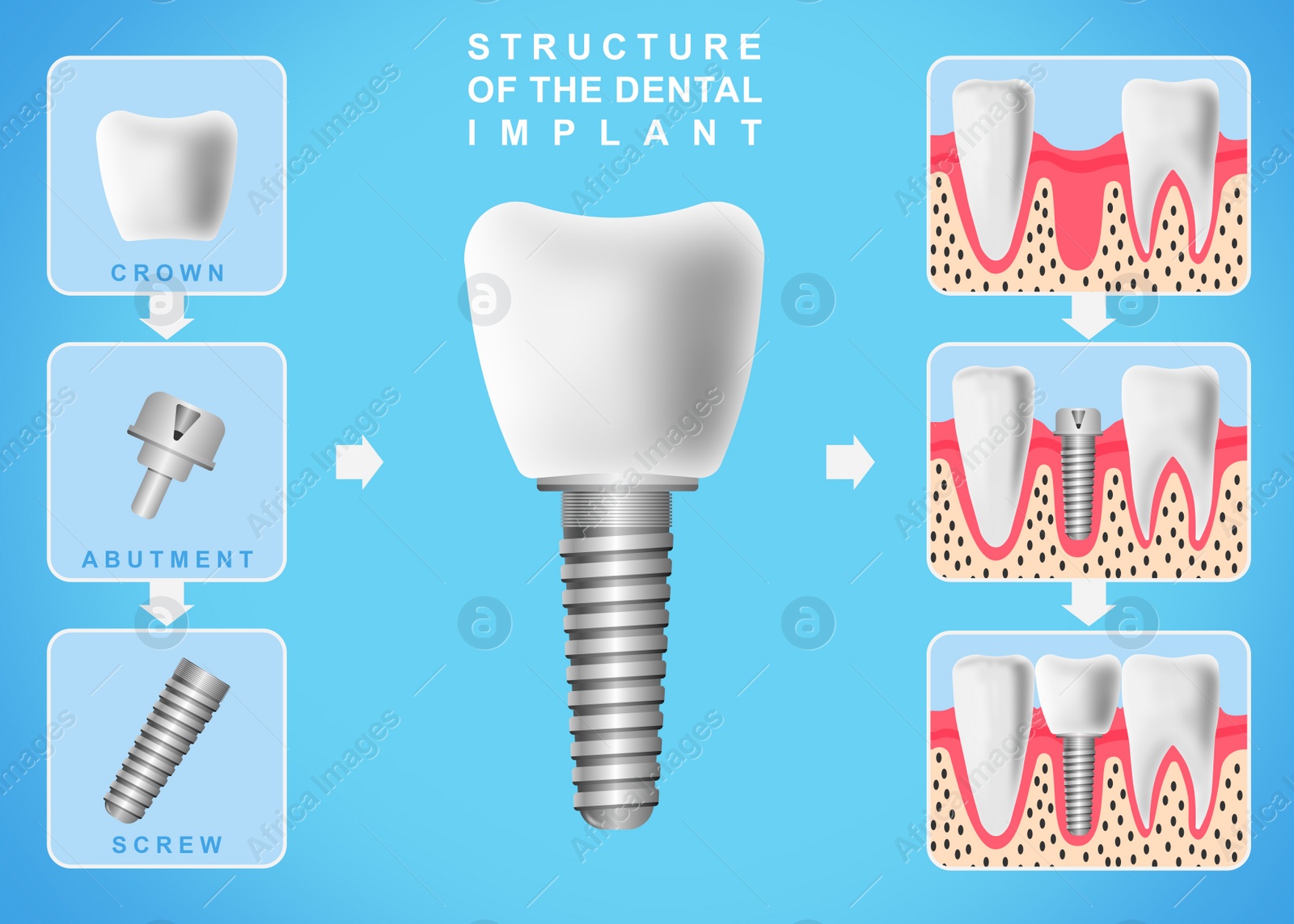 Image of Structure of dental implant on light blue background, illustration. Educational poster