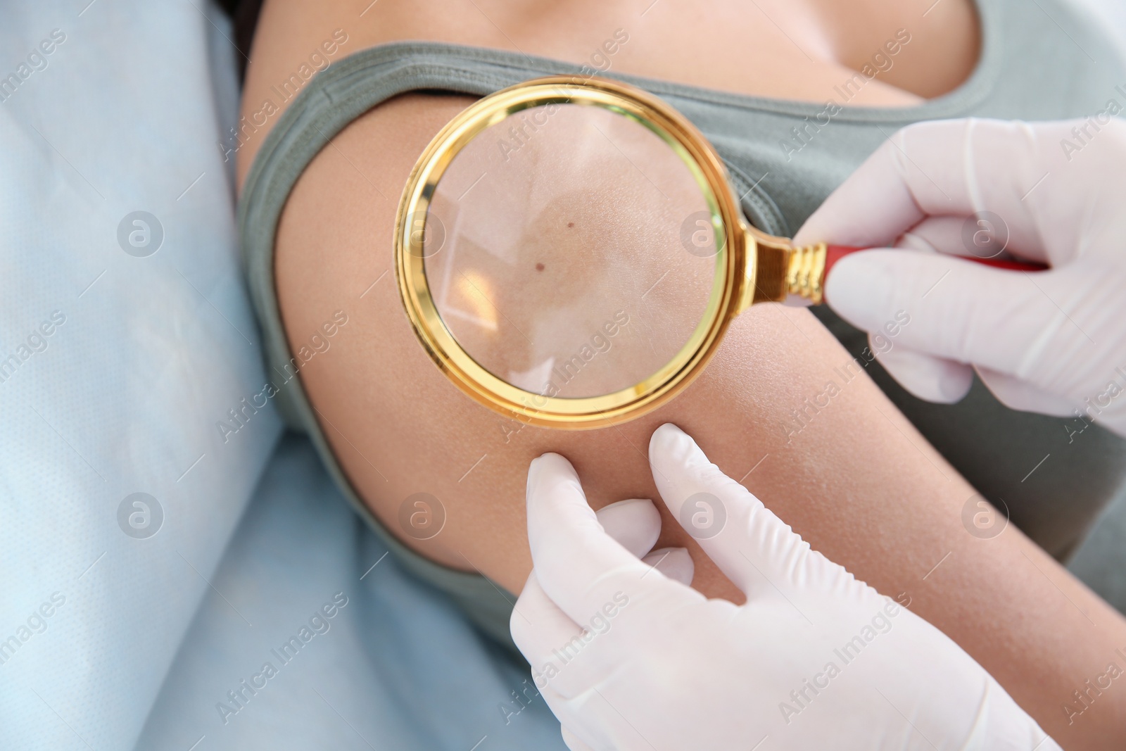 Photo of Dermatologist examining patient's birthmark with magnifying glass in clinic, closeup