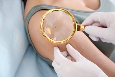Dermatologist examining patient's birthmark with magnifying glass in clinic, closeup