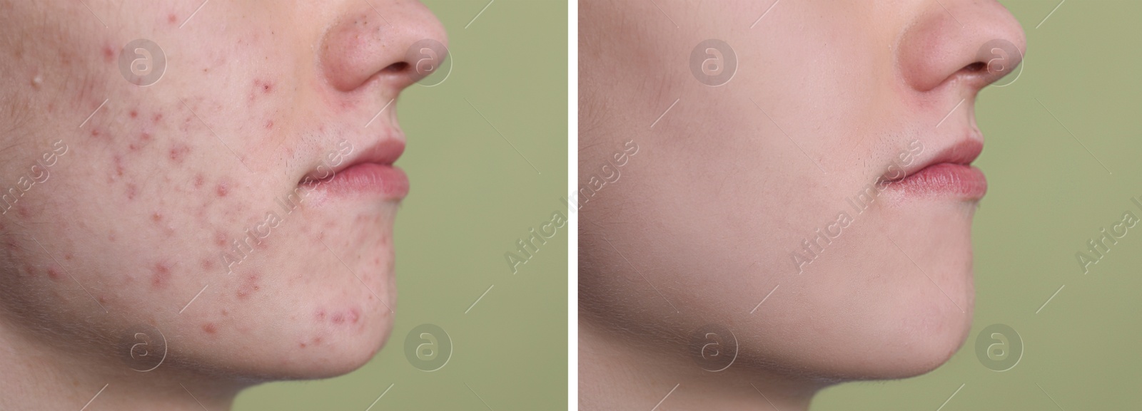 Image of Acne problem. Young man before and after treatment on green background, closeup. Collage of photos