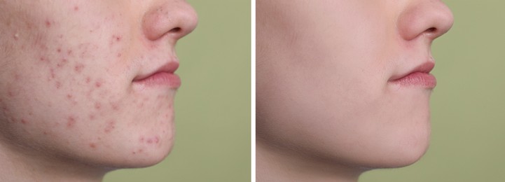 Image of Acne problem. Young man before and after treatment on green background, closeup. Collage of photos