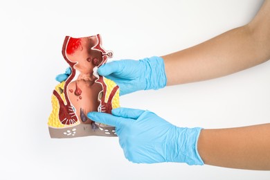 Photo of Proctologist holding anatomical model of rectum with hemorrhoids isolated on white, closeup