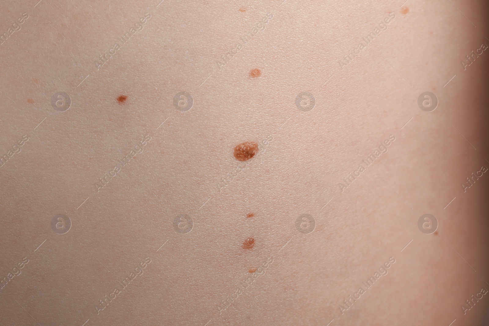 Photo of Closeup of man's body with birthmarks as background