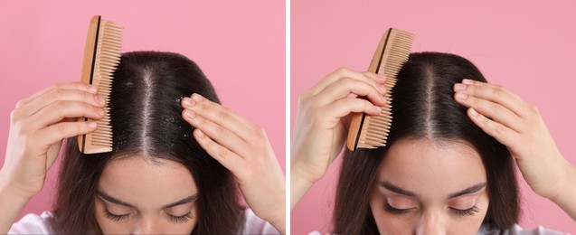 Image of Woman showing hair before and after dandruff treatment on pink background, collage