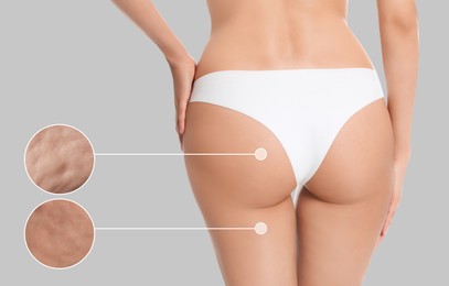 Image of Cellulite problem. Slim woman in underwear on light grey background, closeup. Zoomed skin areas with orange peel syndrome