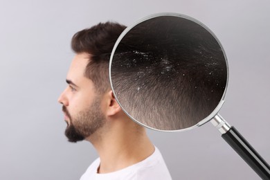 Man suffering from dandruff on light grey background. View through magnifying glass on hair with flakes