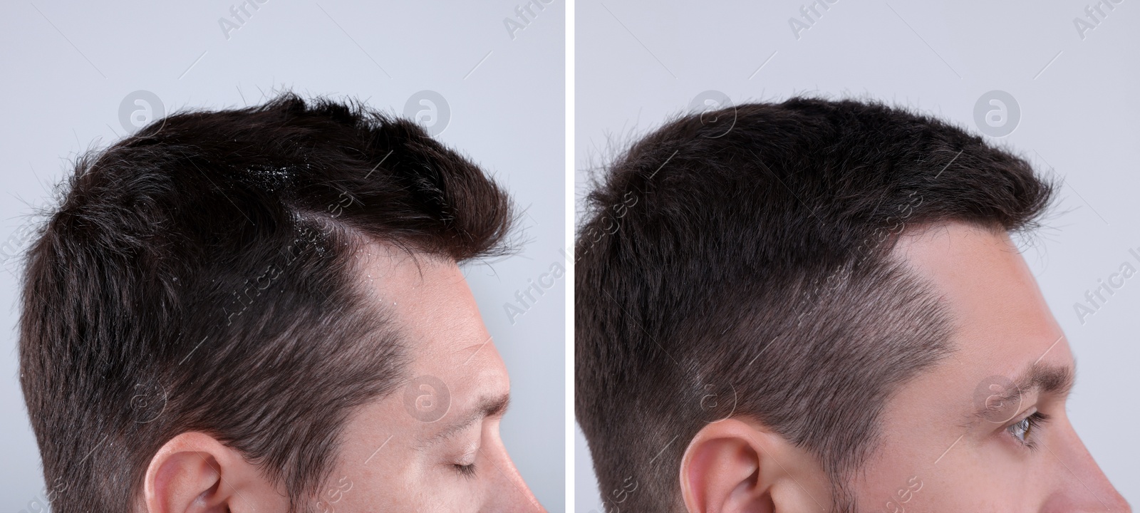 Image of Man showing hair before and after dandruff treatment on grey background, collage